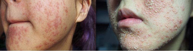 da nhiễm kem trộn